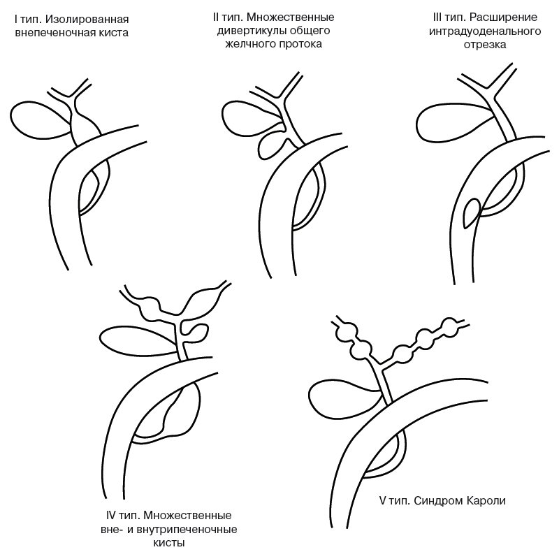 Схематическое изображение дивертикулов желчевыводящей системы