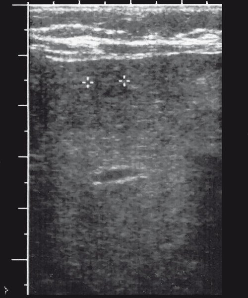 Ультразвуковая картина гемангиомы печени: эхографически на фоне неоднородной по плотности паренхимы визуализируется мелкое кистозное многокамерное образование (выделено маркерами)