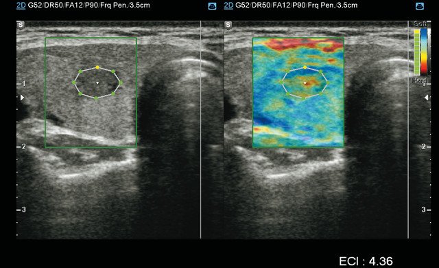 E-Thyroid - количественная оценка эластичности подозрительных образований щитовидной железы (слева - B-режим, справа - эластограмма)