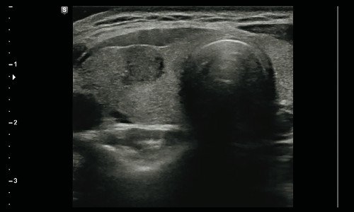 Аксиальное изображение, полученное в В-режиме, показали круглый гетерогенный гипоэхогенный узел размерами 6 х 7 х 8 мм на правой доле щитовидной железы