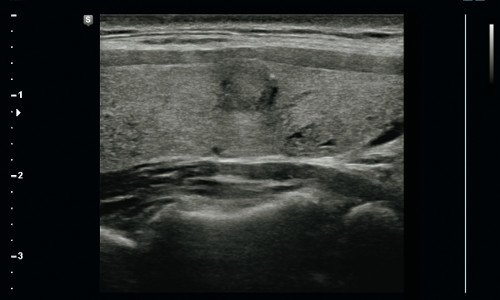 Сагиттальное изображение, полученное в В-режиме, показали круглый гетерогенный гипоэхогенный узел размерами 6 х 7 х 8 мм на правой доле щитовидной железы