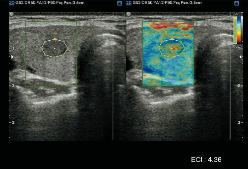 После перемещения датчика в другую плоскость значение ECI составило 4,36, что свидетельствует о злокачественности (выше 3,1), послеоперационное гистологическое исследование подтвердило папиллярную карциному щитовидной железы
