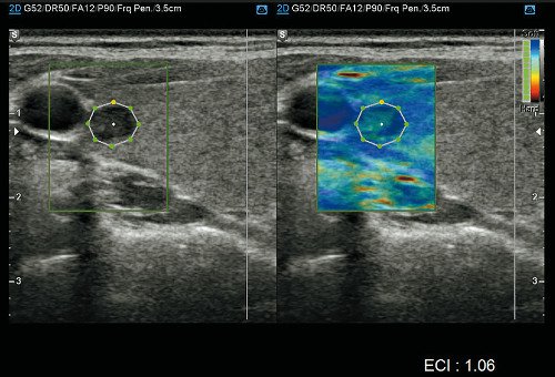 Значение ECI для данного узла составило 1,06, ТАБ подтвердила диагноз тиреоидит Хашимото, и узел оказался доброкачественным