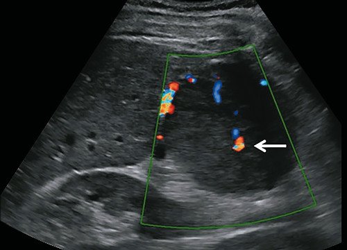 УЗИ печени в режиме ЦДК - в центре этого образования выявлена зона кровотока (стрелка), позволяющая предположить, что образование является очаговой узловой гиперплазией
