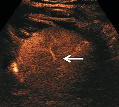 УЗИ печени с контрастированием - после инъекции 2,4 мл препарата Соновью/Лумасон - SonoVue/Lumason через 19 с в артериальной фазе появилась картина 'спицевого колеса' (стрелка) с повышением эхогенности всего образования по сравнению с тканью печени