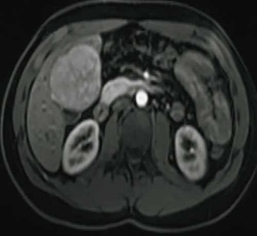 МРТ - аксиальное T2-взвешенное изображение, выявляется образование, по характеристикам аналогичное подозрительной области при УЗИ с контрастированием (CEUS), что позволяет подтвердить диагноз очаговой узловой гиперплазии (FNH)