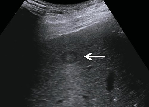УЗИ печени в B-режиме: выявляется четко очерченное образование смешанной эхогенности (стрелка), предположительно метастаз колоректального рака
