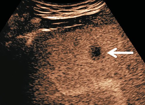 УЗИ печени с контрастированием - через 105 с в конце портальной венозной фазы выявляется вымывание эхоконтраста из образования (стрелка), подтверждающее его злокачественный характер