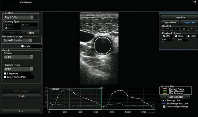 Arterial Analysis - оценка артериальной жесткости в поперечной плоскости