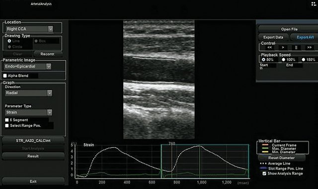 Arterial Analysis - оценка артериальной жесткости в продольной плоскости