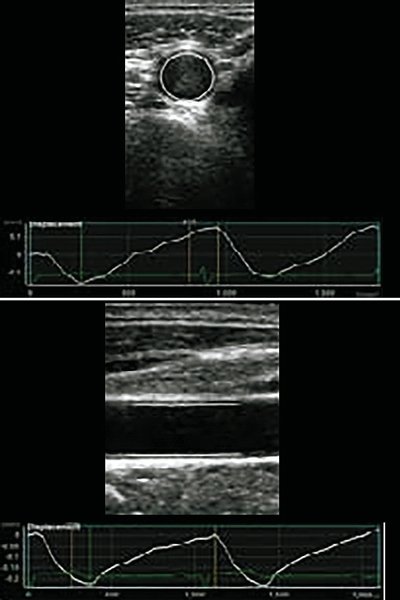 Arterial Analysis - значения циркулярной и радиальной деформации сонной артерии из контрольной группы (A)