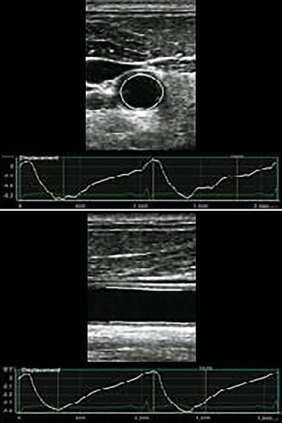 Arterial Analysis - значения циркулярной и радиальной деформации сонной артерии из группы с острым ишемическим инсультом (B)