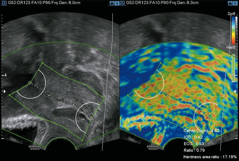 E-Cervix - новая функция УЗ-сканеров Samsung Medison для диагностики преждевременных родов