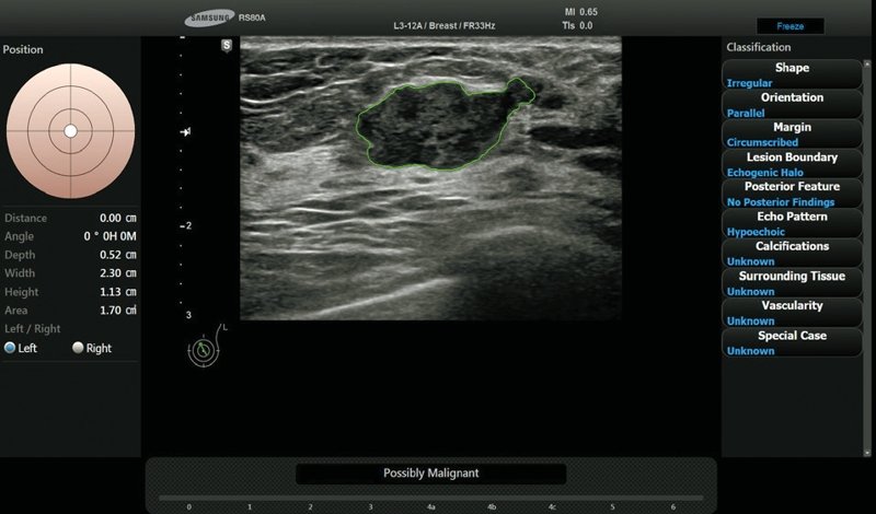 S-Detect for Breast - возможно злокачественное образование