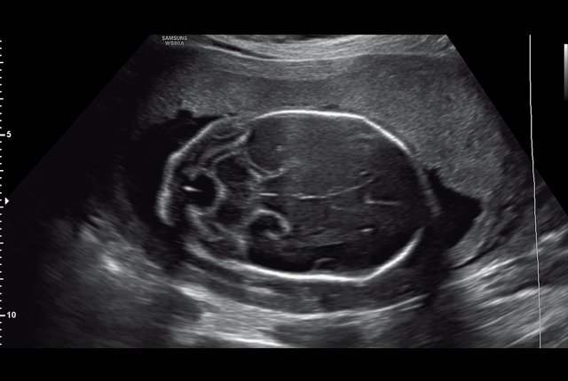 Эхограмма - увеличение шейной складки, расширение большой цистерны головного мозга плода (беременность 21 неделя)