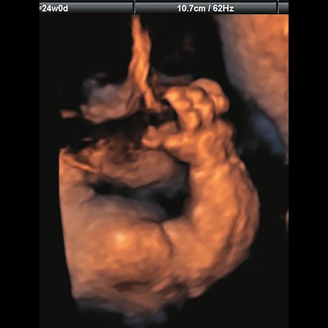 УЗИ плода (3D) - видны правильно установленные пальцы (беременность 24 нед)