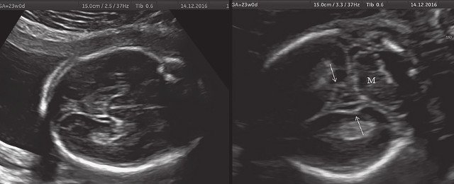 УЗИ плода - нормальная картина нижнесагиттального и коронарного срезов нижней поверхности височных долей мозга плода (беременность 23 нед)