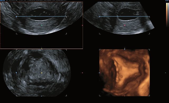 ЭхоГСГ - неизмененная нормально контрастируемая полость матки, режим 3D (г)
