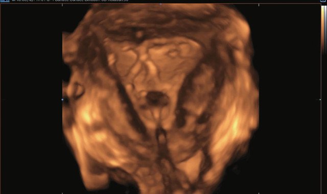 Патология полости матки - режим 3D-contrast ЭхоГСГ