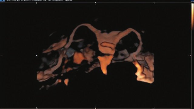 Свободно проходимые маточные трубы с обеих сторон: визуализация контраста в периовариальных пространствах с двух сторон (режим 3D-contrast ЭхоГСГ)
