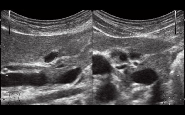 Эхограмма дивертикула задней стенки желчного пузыря после пищевой нагрузки