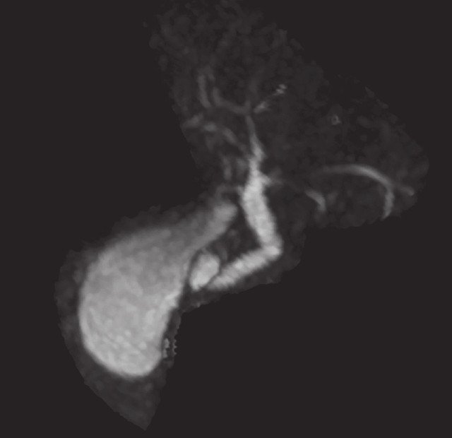 МР-холангиопанкреатограмма органов брюшной полости и забрюшинного пространства