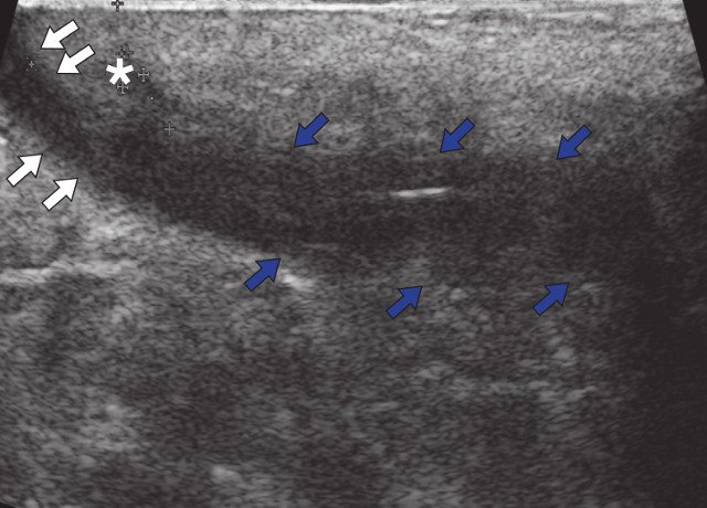 УЗИ мягких тканей крестцово-копчиковой области - эпителиальный копчиковый ход (синие стрелки); краниально расположенный свищевой ход (белые стрелки) и формирующийся свищевой ход (звездочка), В-режим