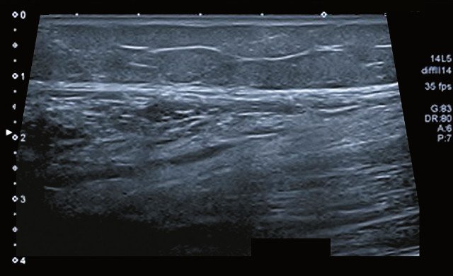 Эхограмма двуглавой мышцы плеча подростка, находящегося в длительной ремиссии онкологического заболевания: типичный рисунок мышцы полностью утрачен, выделить собственно мышечную и соединительную ткань невозможно