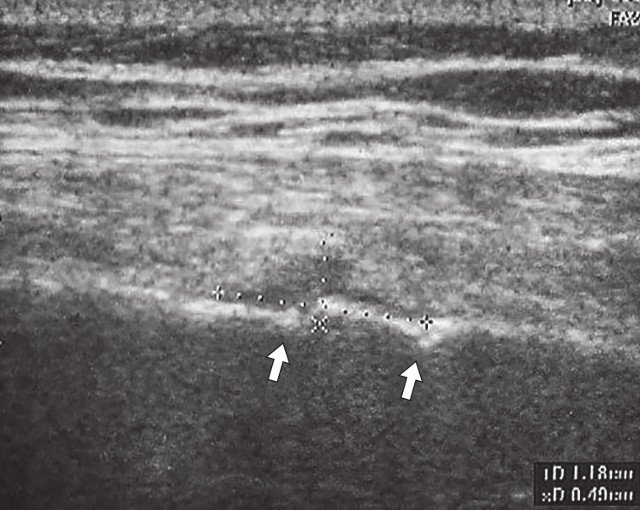 Двойной окончатый перелом VII ребра правой половины грудной клетки (указан стрелками)