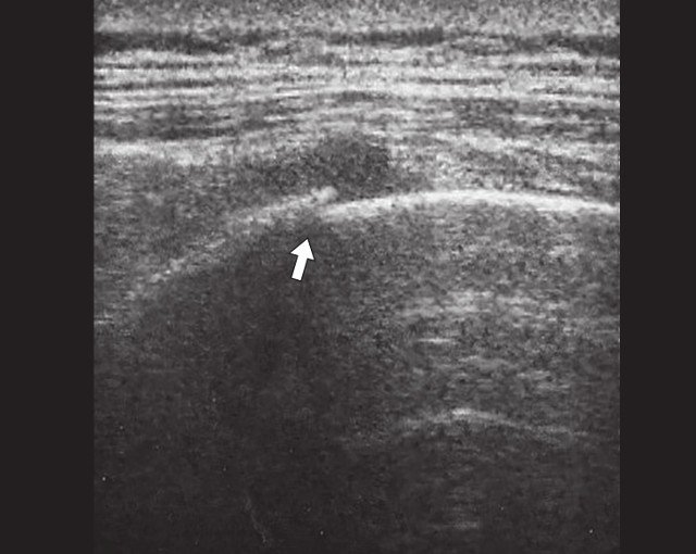 Косой перелом VIII ребра правой половины грудной клетки (указан стрелкой)