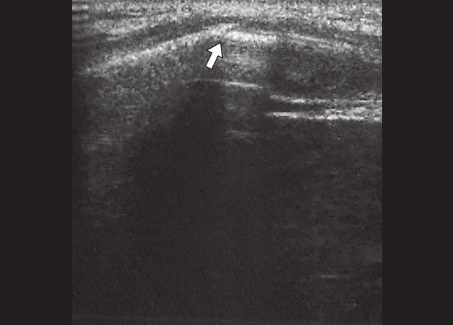 Косой перелом ребер нижнебоковых отделов грудной клетки (указан стрелкой)