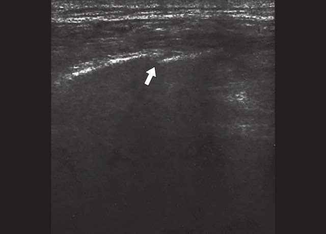 Косой перелом ребер нижнебоковых отделов грудной клетки (указан стрелкой)