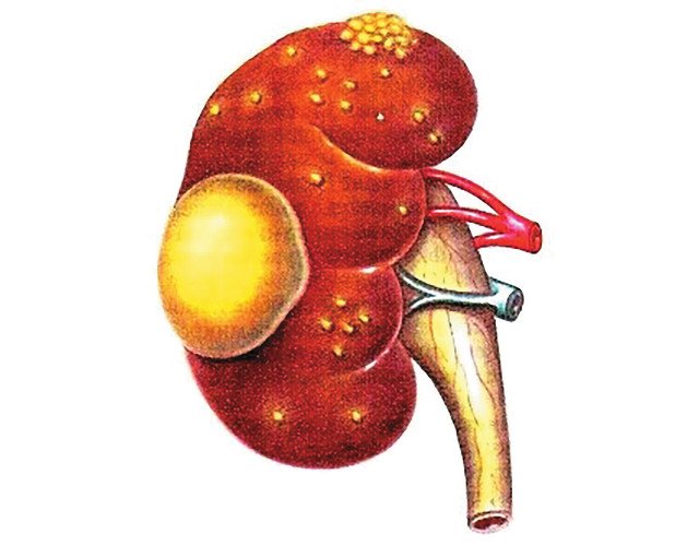 Абсцесс почки