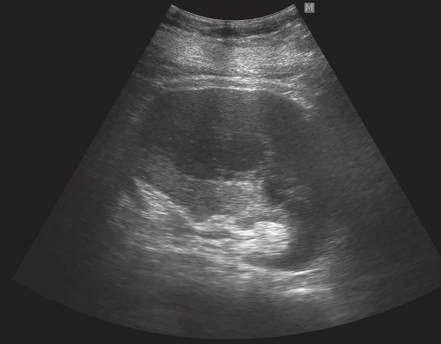 Подкапусульно в левой почке визуализируется жидкостное образование размерами 104 х 62 см, с перегородками внутри и гиперэхогенной взвесью