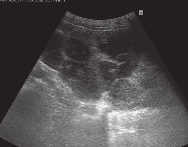 Ультразвуковая картина поликистоза почек. Наличие множественных анэхогенных образований различного диаметра