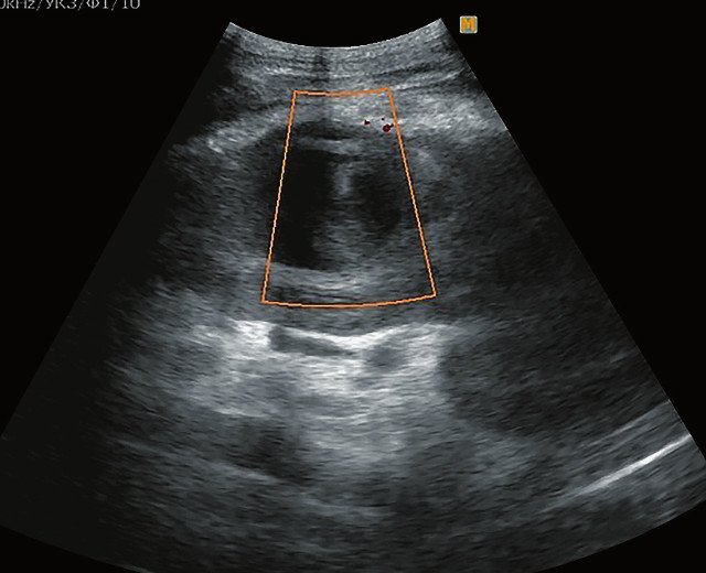 Образование без цдк. УЗИ почек с ЦДК. Абсцесс почки УЗИ картина.