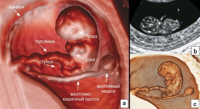Анатомическое строение эмбриона и придатков матки на 8-й неделе беременности - визуализация с помощью RealisticVue (a), обычного двухмерного УЗИ (b) и классической поверхностной 3D реконструкции (c)