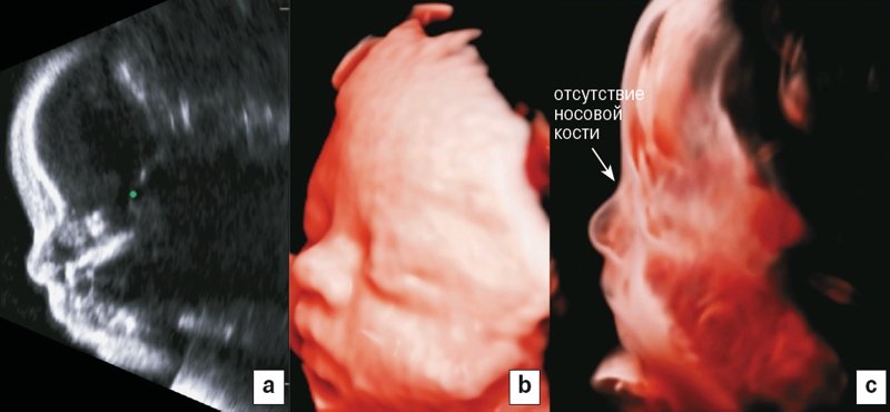 Плод с трисомией 21 (III триместр беременности) - изображение лица плода при двухмерном УЗИ (a), RealisticVue (b) и CrystalVue (c) - отсутствие носовой кости у плода четко видно только на изображении (c)