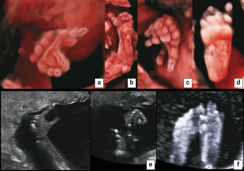 Пороки развития пальцев рук и ног - CrystalVue (a-d) и двухмерное УЗИ (e-f)