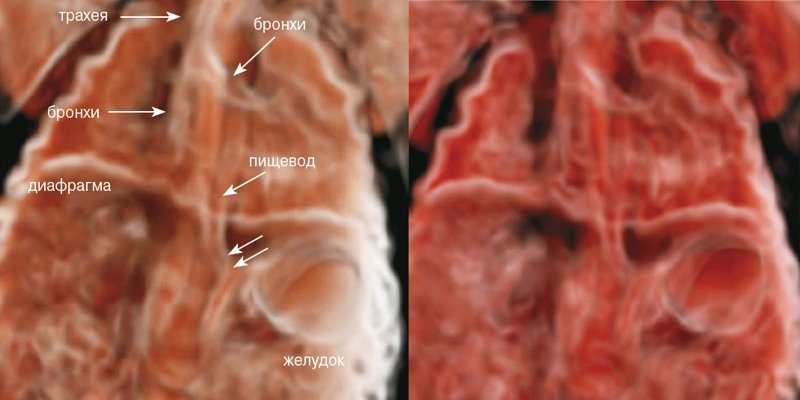 CrystalVue - реконструкция анатомии грудной клетки и брюшной полости