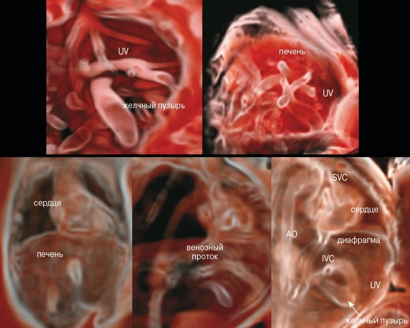 CrystalVue - реконструкция органов и сосудов грудной и брюшной полостей: пупочная вена (UV - umbilical vein), аорта (AO - aorta), верхняя полая вена (SVC - superior vena cava), нижняя полая вена (IVC - inferior vena cava)