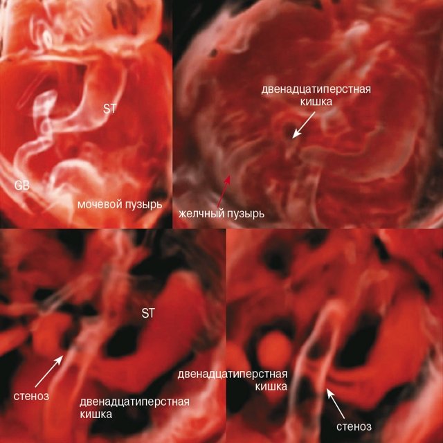 CrystalVue - стеноз двенадцатиперстной кишки (белая стрелка), желудок (ST - stomach), желчный пузырь (GB - gallbladder; красная стрелка)