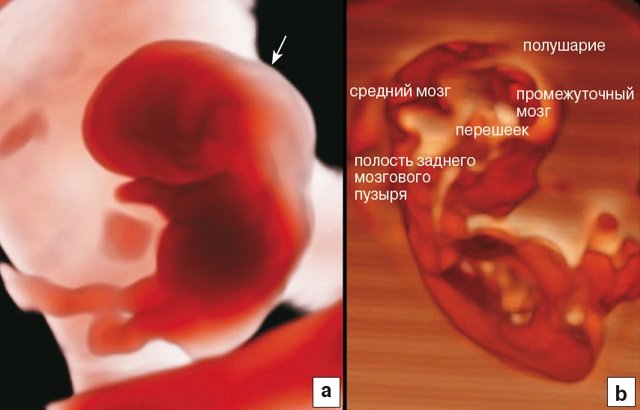 RealisticVue - визуализация анатомических структур эмбриона на 9-й неделе беременности