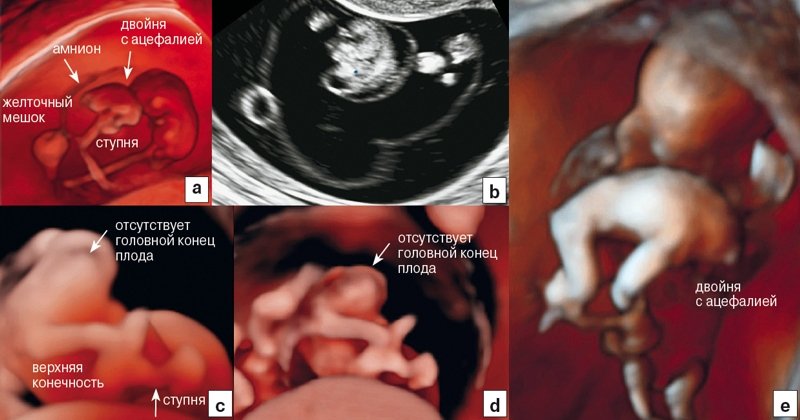RealisticVue - редкий случай беременности (двойня): плоды с отсутствием головы и сердца, но с одним хорионом и одним амнионом