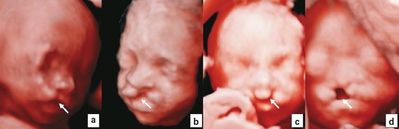 RealisticVue - дефекты орофациального развития: изолированная расщелина нёба (a), односторонняя расщелина губы и нёба (b), двусторонняя расщелина губы и нёба (c), срединная расщелина губы и нёба и расщелина нёба с агенезией носа (d)