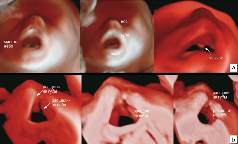 RealisticVue - визуализация ротовой полости, нёба и язычка плода с нормальной анатомией (a) и с расщелиной губы и нёба (b)