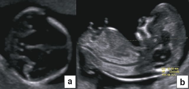 Оценка гестационного возраста в начале беременности с помощью измерения БПР (a) и КТР (b)