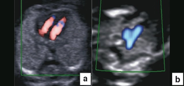 Эхокардиография плода на ранних сроках в цветовом энергетическом допплеровском режиме - визуализируются четыре камеры (a) и срез через три сосуда и трахею (b)