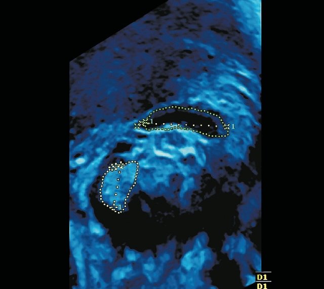 УЗИ головного мозга плода - 3D изображение в срединно-сагиттальной проекции (видны мозолистое тело и червь мозжечка, указаны их длина и измеренная длина окружности)