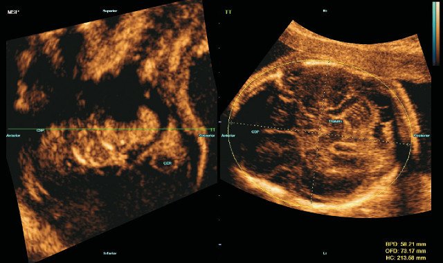 УЗИ головного мозга плода - трансталамическая плоскость